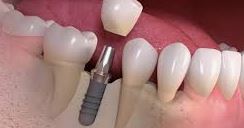 Dental Implants in Adelaide