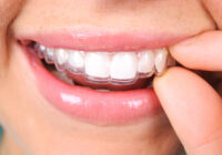 Invisalign Adelaide